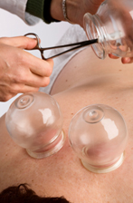 Acupuncturist applying vacuum cupping treatment to patients back